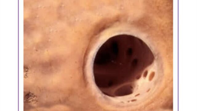 Выдавливание прыщей и черных точек под микроскопом