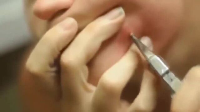 Огромный чирий на лице. удаление (много гноя)