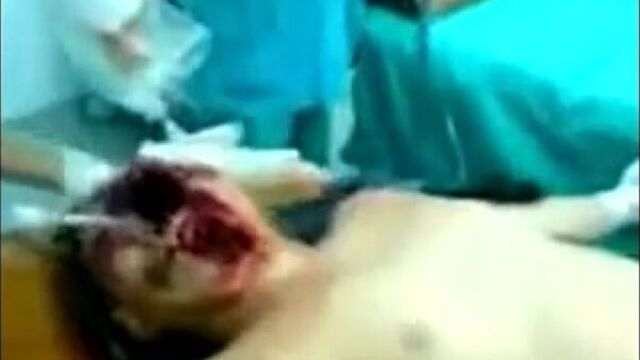 Парень прыгнул в воду с 10 метровой высоты и разбил голову об камень на две част