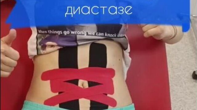 Тейпирование при диастазе прямых мышц живота.