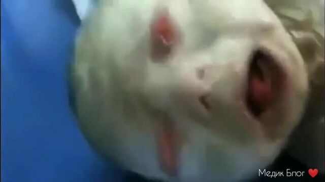 Ихтиоз арлекина